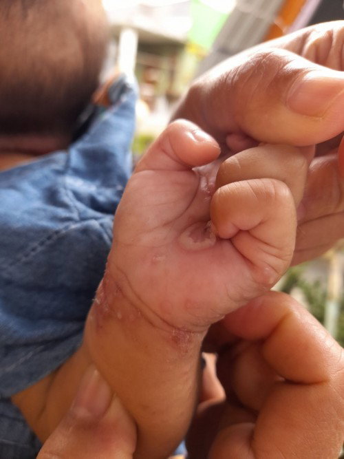 Skabies Pada Bayi