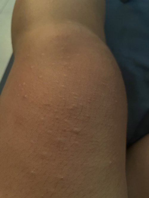 Itchy Skin During Pregnancy