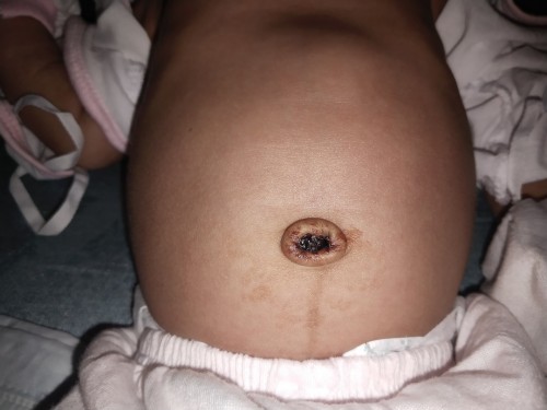 Hello po mga mommies... normal lang po ba ganito itsura ng pusod ng 19 day old baby ko?
