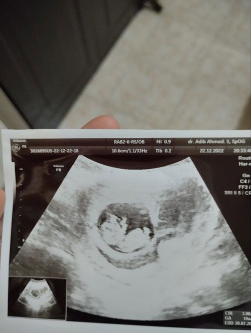 Plasenta kurang menempel