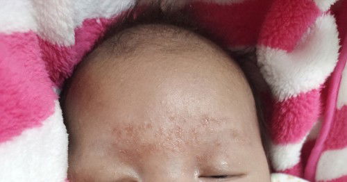 ผื่นแดงมีน้ำซึมออก