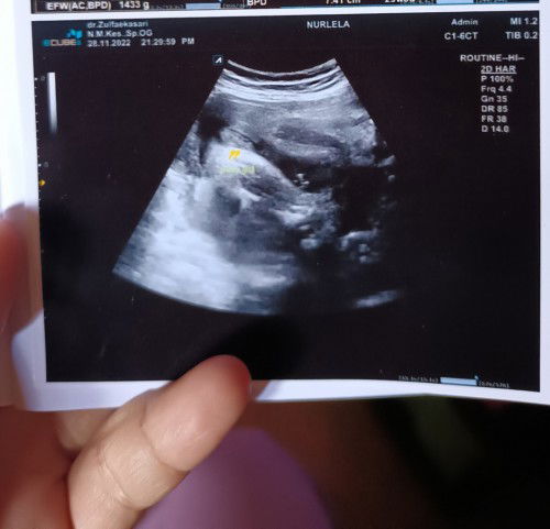 Benar gak sih ini hasil usg jk nya cewek??