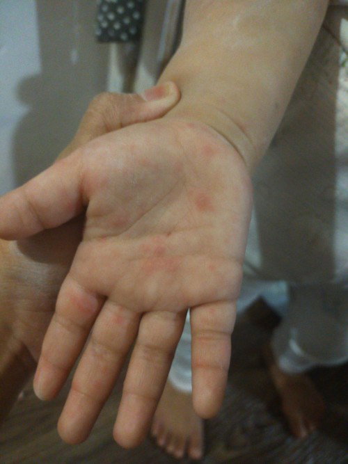 Allergy Kya to o tigdas???