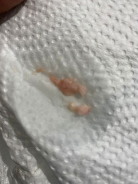 Keputihan plus darah