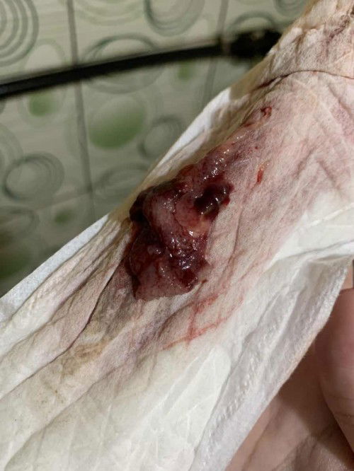 pengalaman injection depo perancang keluarga 😭