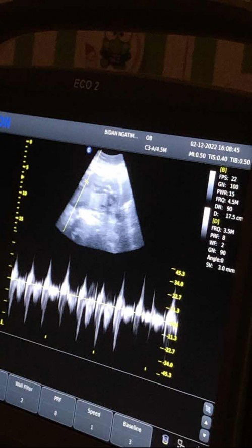 cara baca hasil usg 2D