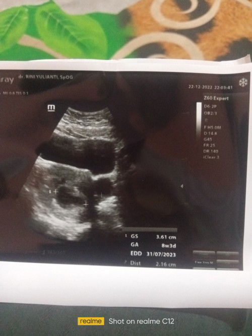 Hamil 8 minggu masih kantung dan ada kista