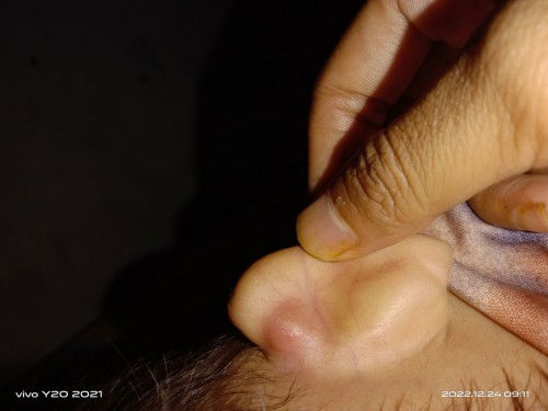 Benjolan keras seperti Tulang di blg daun telinga