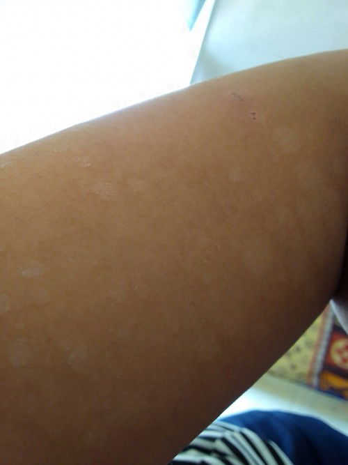 Bingung berobat kulit atau jangan saat hamil