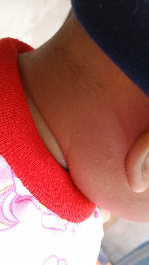 น้องเป็นผื่นแบบนี้แพ้อะไรคะ