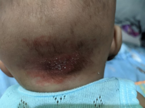 kulit kepala memerah dan kering