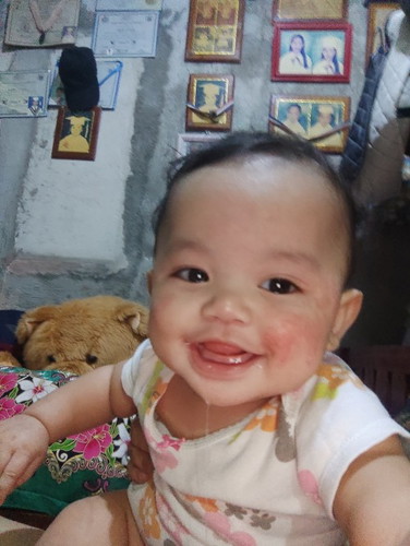 Rushes sa face ni baby