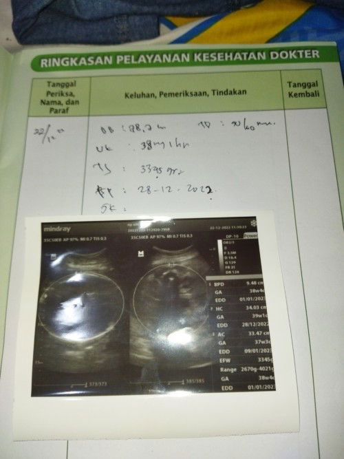 Assalamu'alaikum Bunda. Mau tanya barusan akukan hbs di USG, tp kata dr nya udh minggu ke 38.. Jjur