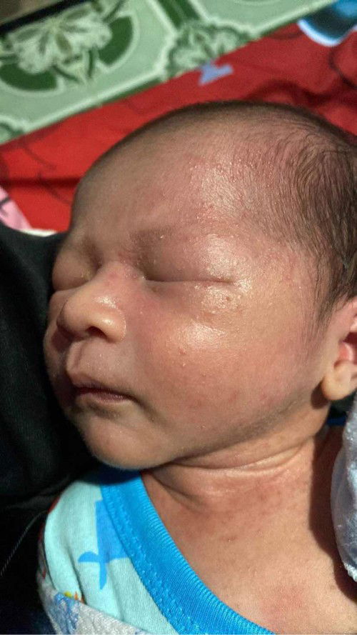 ผื่นแบบนี้คือผื่นอะไร