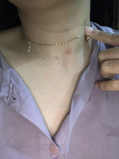 Bentol gatal di tm 2