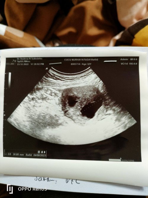 Hamil BO dan harus kuret