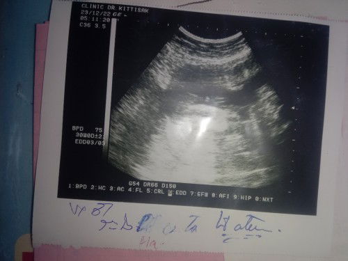 สอบถามเรื่องรกเกาะต่ำ ใครมีประสบการณ์มาแชร์กันหน่อยค่ะ