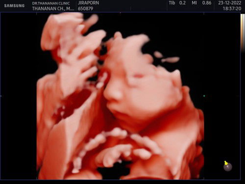 25สัปดาห์ น้ำหนักลูกเท่าไหร่กันคะแม่