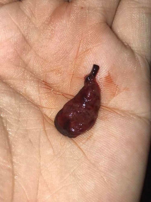 แบบนี้คือแท้งใช่มั้ยค่ะ