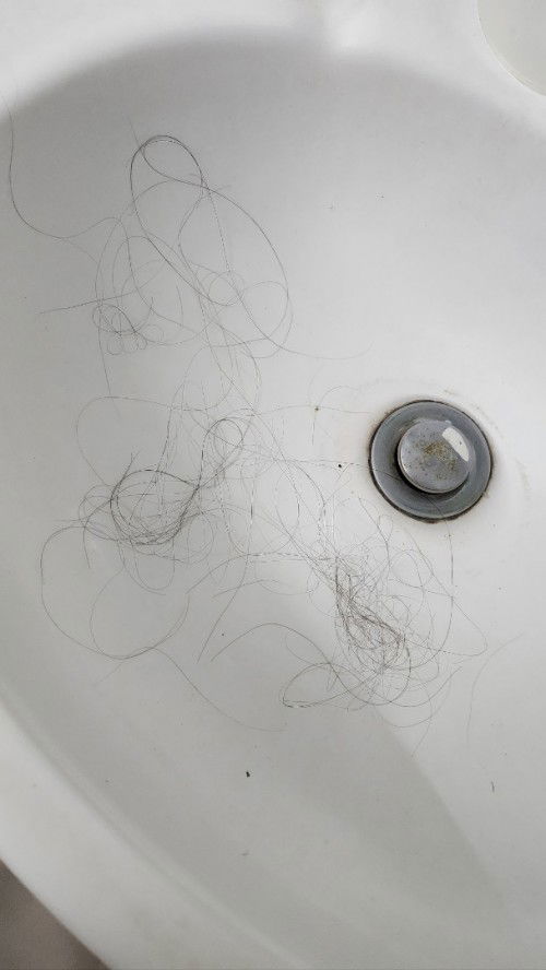 Rụng tóc sau sinh.