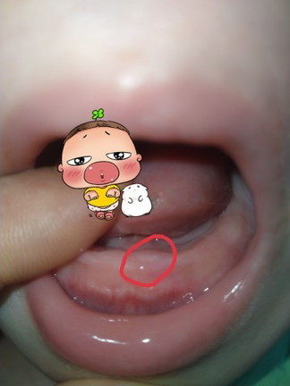 Các mom nhìn giúp em bé sắp mọc răng đúng không ạ