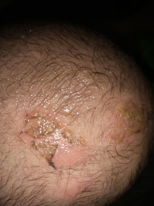 Obat yang aman untuk kepala bayi..??