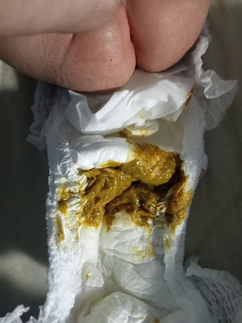 อึสีแบบนี้ท้องเสียหรือเปล่า?