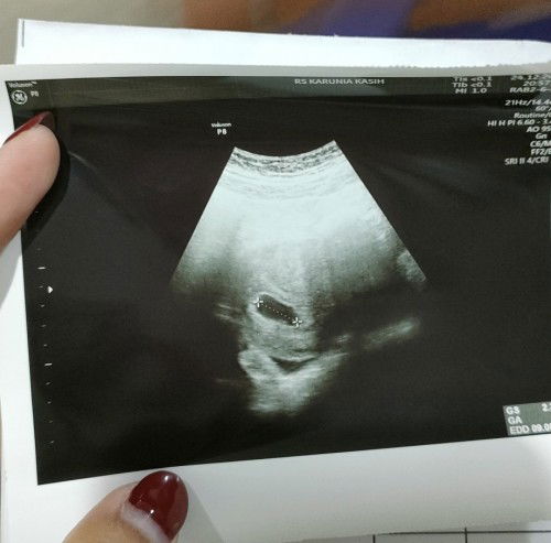 USIA KANDUNGAN 6 - 7 WEEK TAPI USG MASIH KELIHATAN KANTONG SAJA