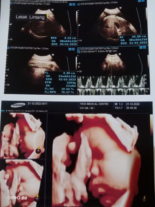 Bun ini hasil USG tgl 21 des,hpl nya jd maju Krn BBJ gede,hpl awal 15 Jan(37w klo dihitung HR ni)