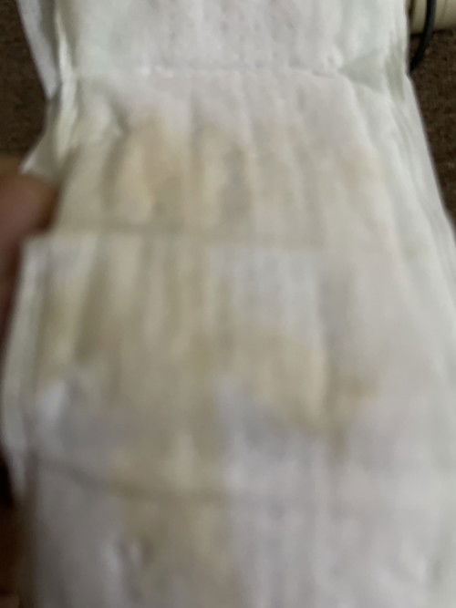 keputihan kuning encer apakah flek?