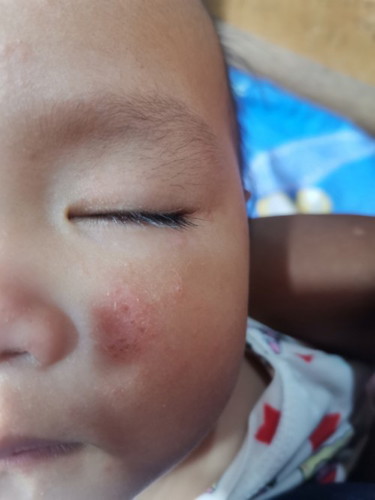 Rashes sa mukha ni baby