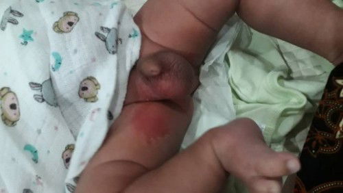 melecet celah peha baby