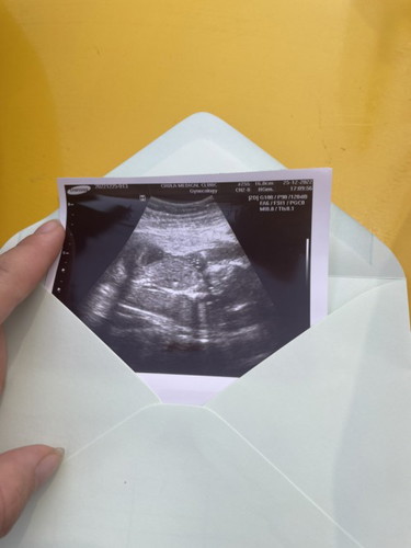 4เดือนแล้วท้องน้องยังเล็กอันนี่ปกติไมคะท้องแรกคะแต่ไปตรวจแล้วหมอบอกน้องปกติแต่ท้องแม่ยังเล็กเหมือนไม่ท้องเลยคะปกติไมคะท้องแรก