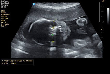 Assalamualaikum mummy to be semua. Alhamdulillah gmbr scan dibawah masa 24week 4day,jom teka jantina