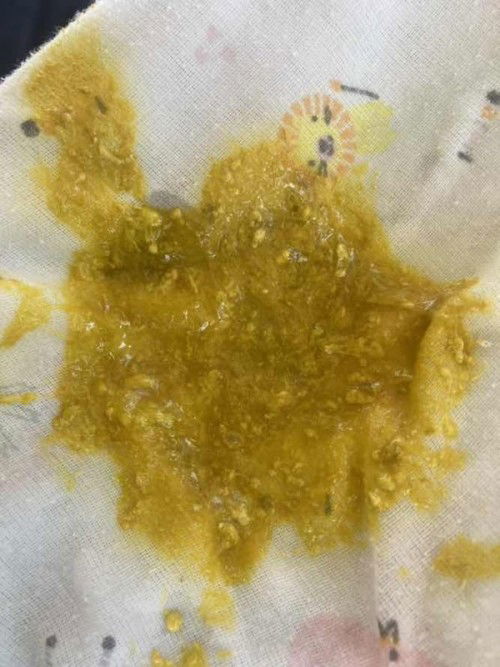 น้อง2เดือนกว่าถ่ายแบบนี้ปกติไหมค่ะ