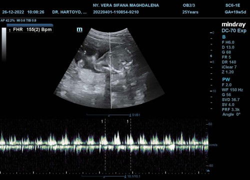 Janin yang aktif banget