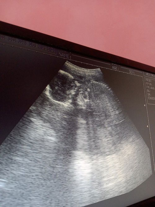 22 weeks breech position sino po dito yung hindi makita gender dahil suhi si baby?