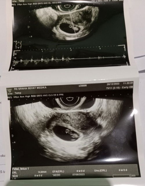 Usg Kehamilan 8 weeks