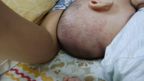 Biang Keringat pada bayi 4 bulan