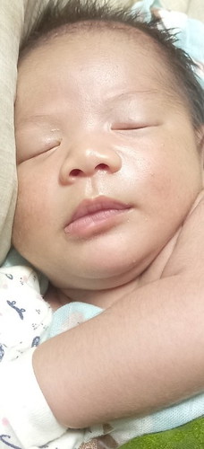 Salam mommy 
Kt sini tumpang tanya 
Kulit muka baby knp jadi mcm ni ya penyebab apa ya