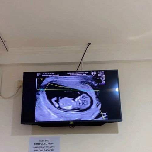 Usia kehamilan 14 mgg