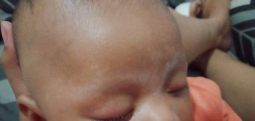 Bercak putih pada wajah bayi