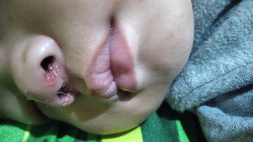 Hidung iritasi parah