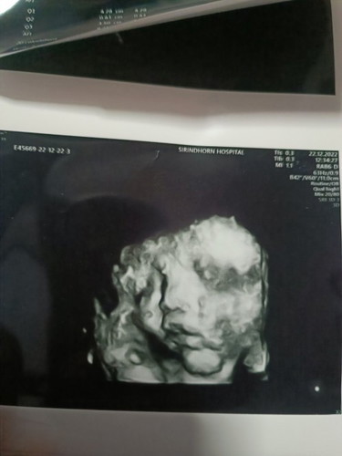 ตอนนี้36วีคอยากรู้ว่าน้องหนัก2400ตัวเล็กไปไหมคะ?