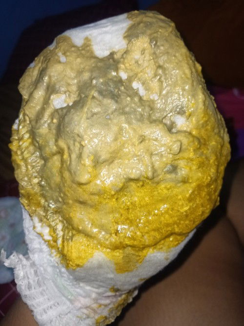 น้องอายุ3เดือนอึแบบนี้ผิดปกติไหม