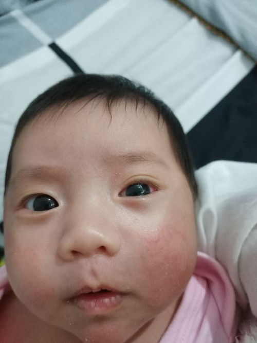 แม่ๆ ท่านไหนเคยมีประสบการณ์ลูกตาแดงบ้างคะ