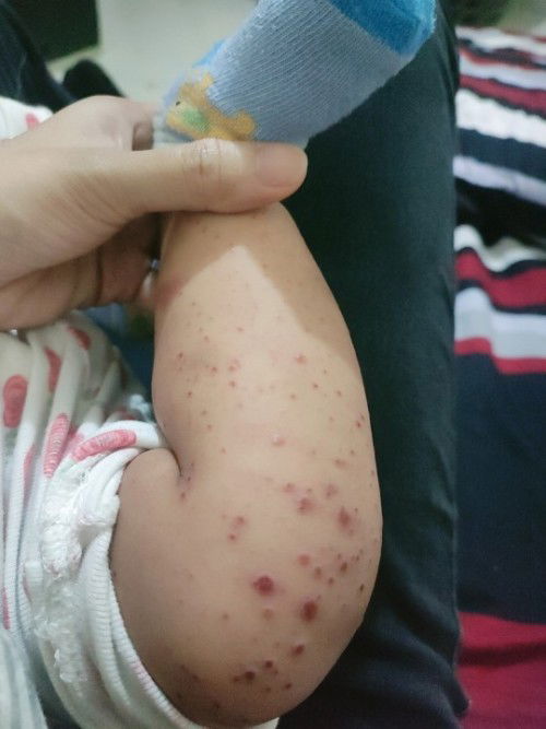 Hi mga mommmy ano po kaya mabisang gamot sa peklat