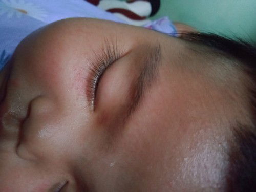 beruntusan di wajah bayi