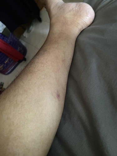 Normal ke kalau keluar urat biru kat betis/kaki?