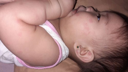 HFMD or just Rashes?